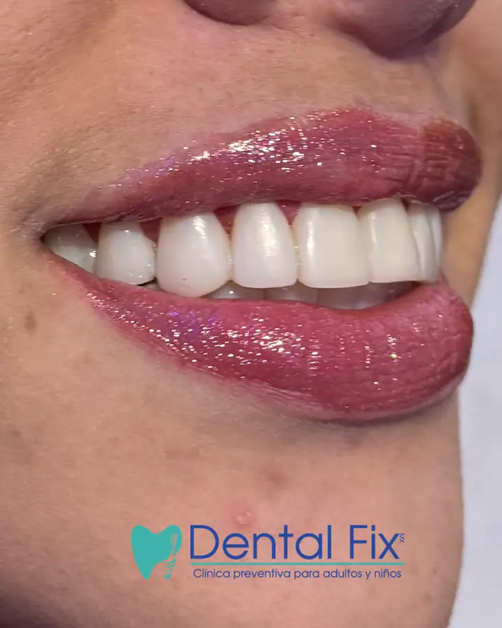 Caso de alta estética dental con sonrisa a la medida