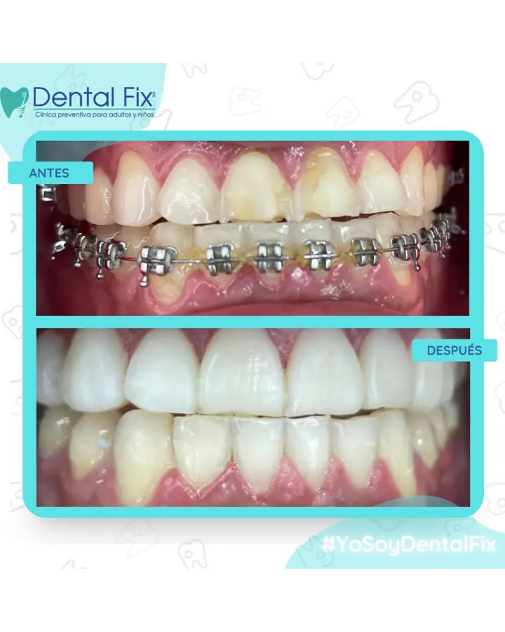 Antes con brackets y después del tratamiento de ortodoncia