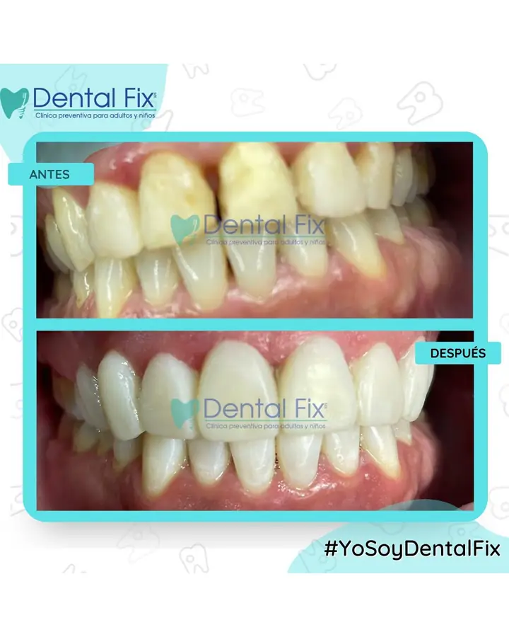 Antes y después de un diseño de sonrisa en vista lateral