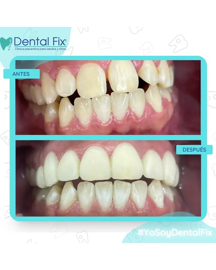 Antes y después de un diseño de sonrisa con dientes alineados