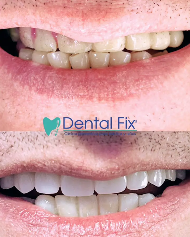 Antes y después donde cambia la forma de los dientes, no solo el tono
