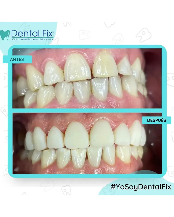 Antes y después de un diseño de sonrisa sin desgaste dental