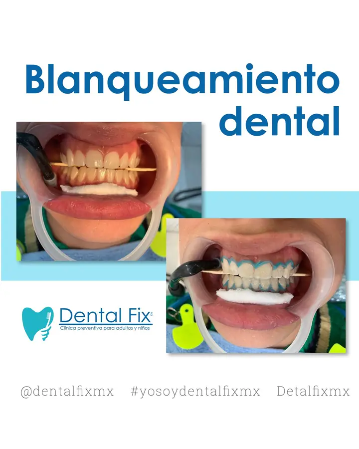 Antes y después de un blanqueamiento dental en consultorio