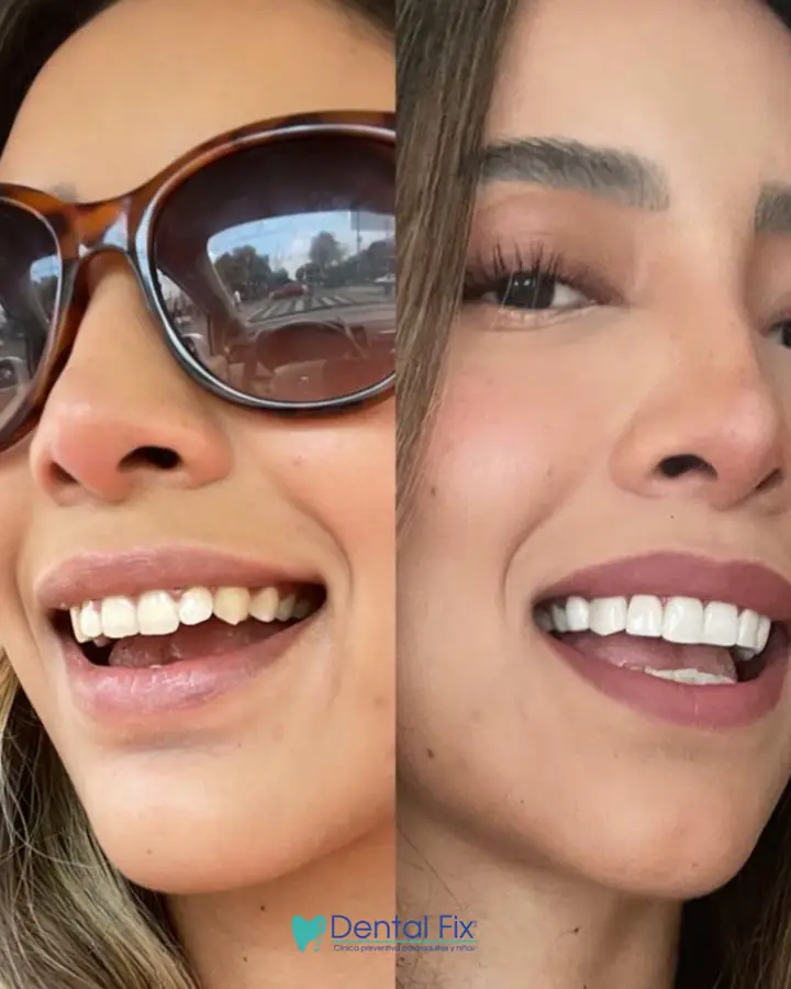 Antes y después de un cambio de carillas dentales en CDMX
