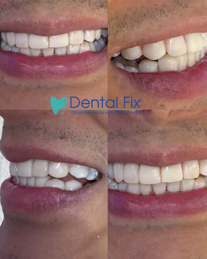 Cambio de sonrisa documentado desde cuatro ángulos