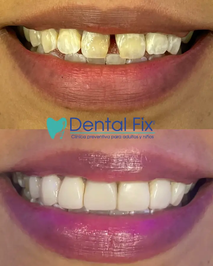 Cambio estético dental resuelto en pocas citas