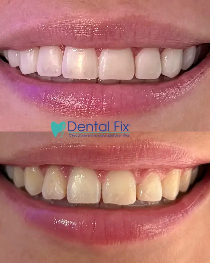 Carillas de resina con acabado natural en paciente de DentalFix