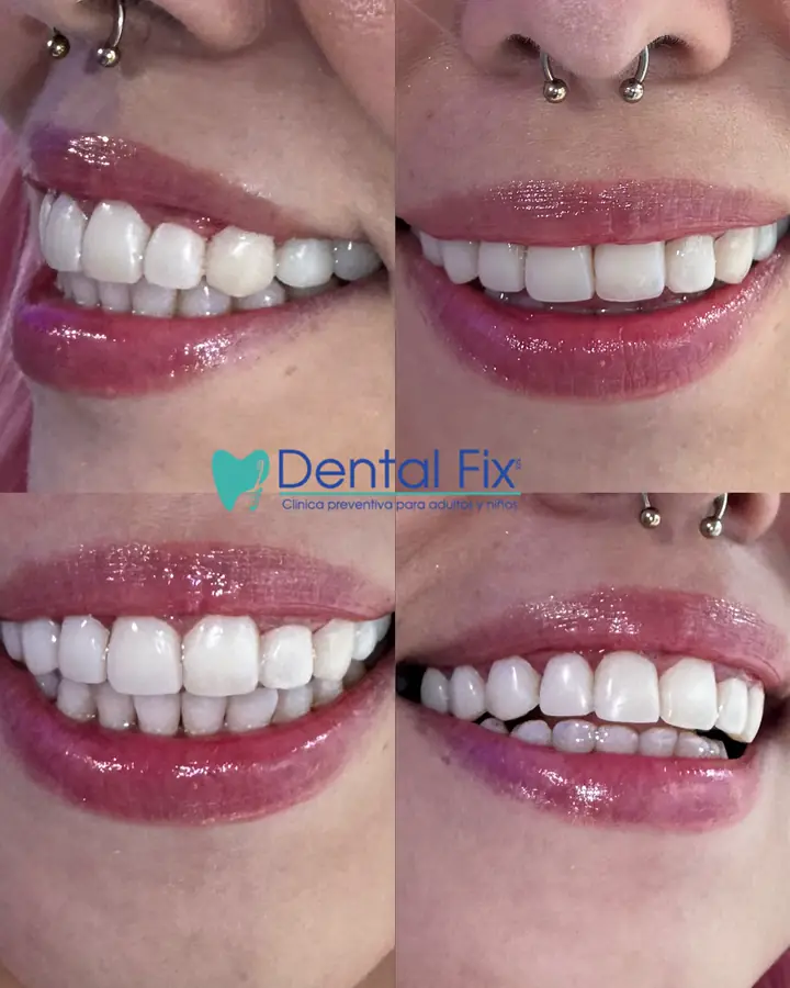Caso completo de diseño de sonrisa en paciente de DentalFix