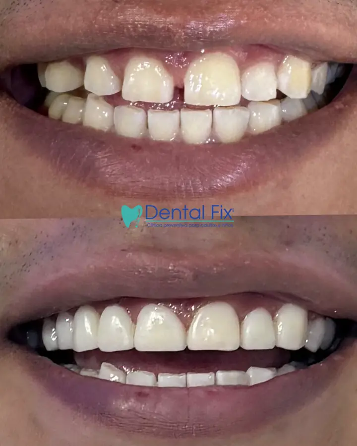 Cierre de diastema mediante diseño de sonrisa sin desgaste