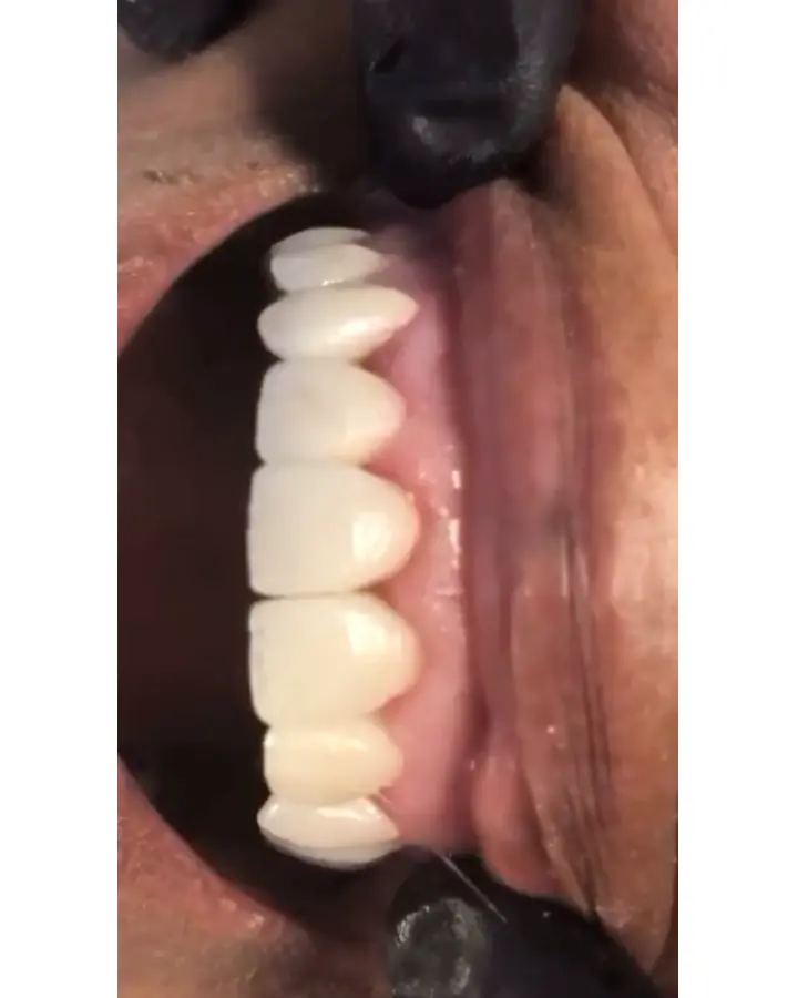 Antes y después de la colocación de coronas dentales
