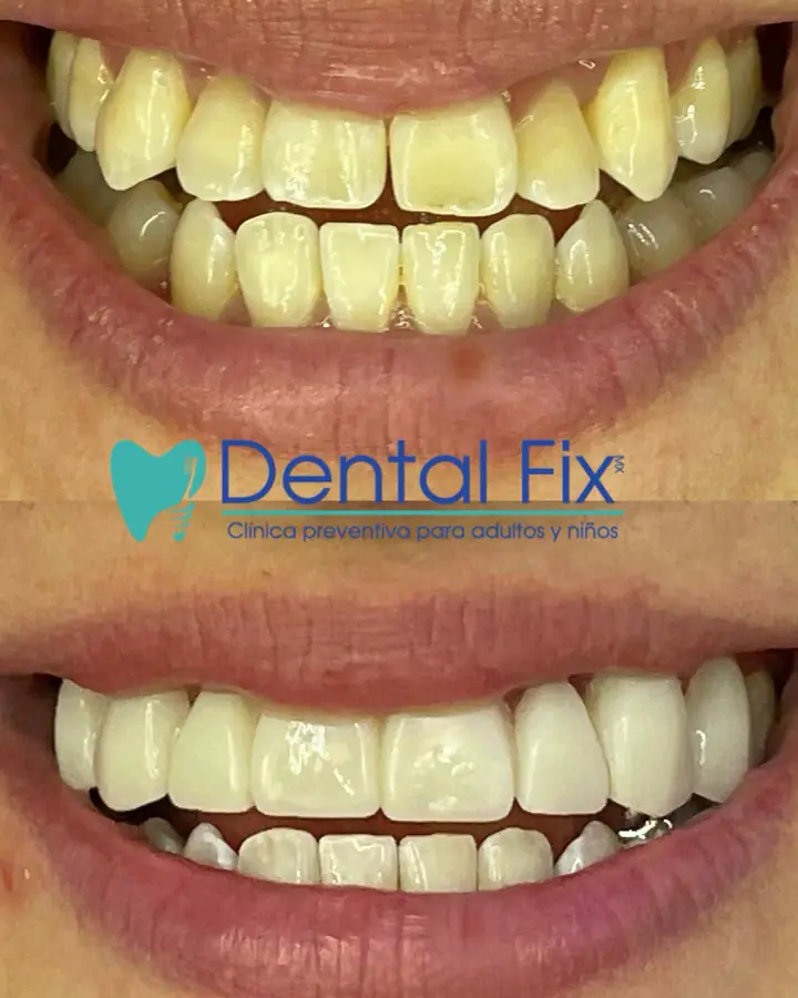 Antes y después de dientes amarillos y desgastados