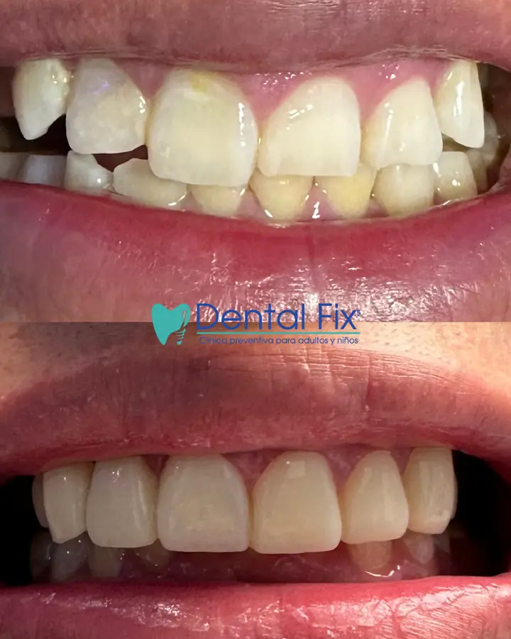 Antes y después de dientes apiñados corregidos estéticamente