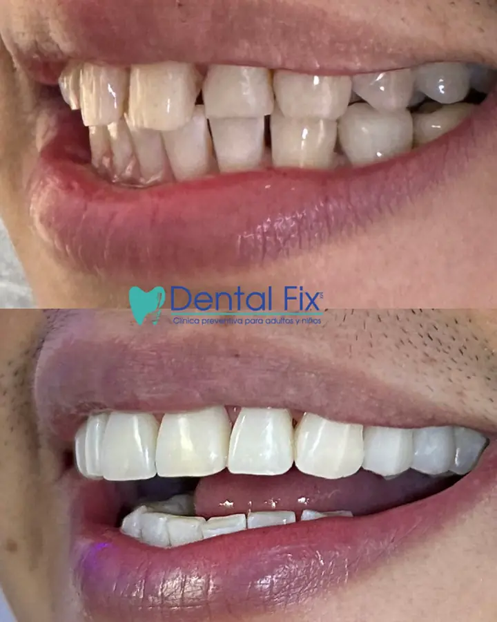 Antes y después de dientes desgastados restaurados