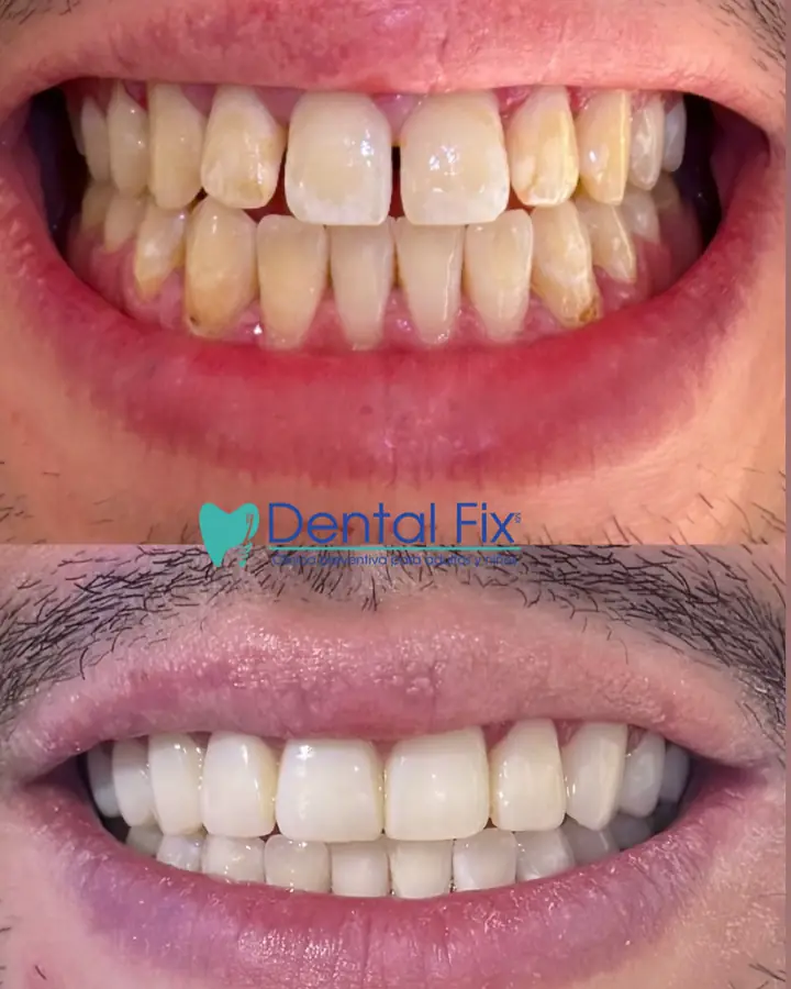 Antes y después en un caso de dientes manchados y desgastados