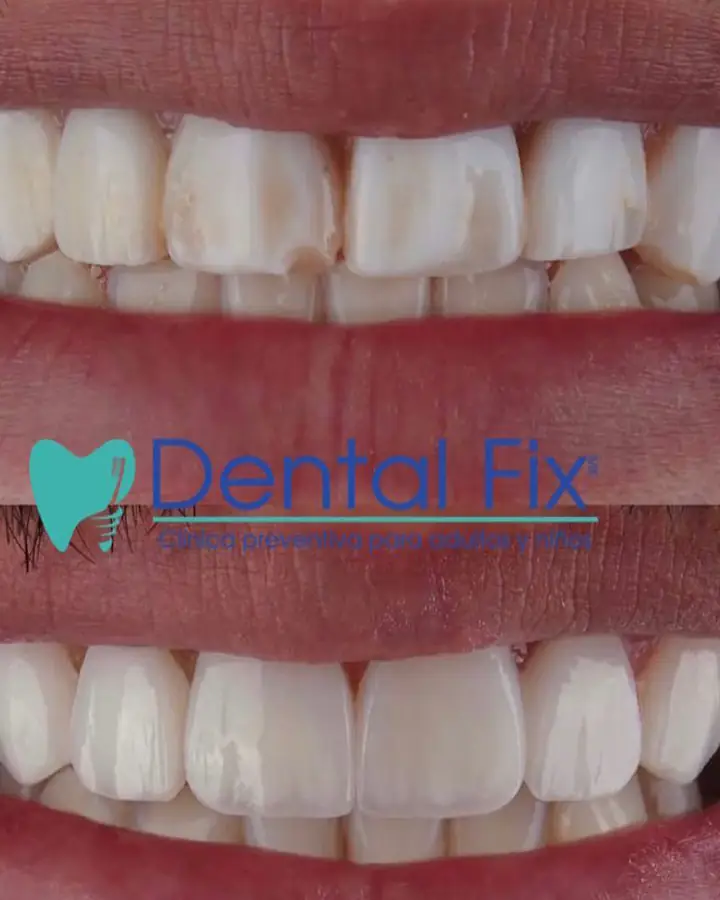 Antes y después del cierre de espacios entre los dientes