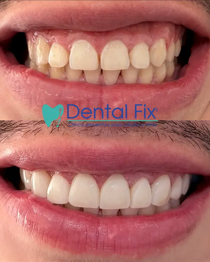 Diseño de sonrisa con resina compuesta trabajada capa por capa