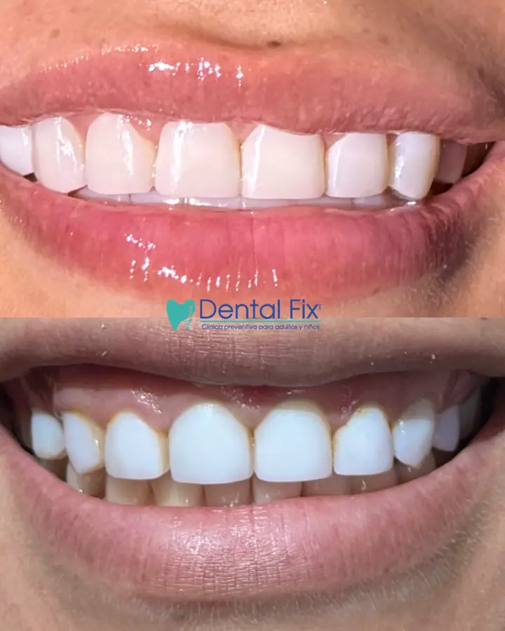 Resultado de diseño de sonrisa personalizado en paciente de DentalFix