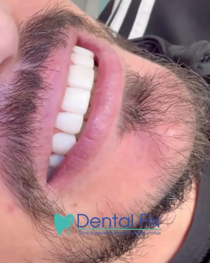 Reel de transformación de sonrisa sin desgaste del diente natural