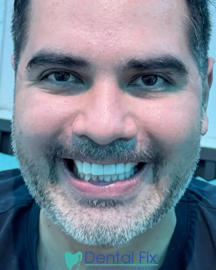 Reel de diseño de sonrisa sin desgaste dental en DentalFix