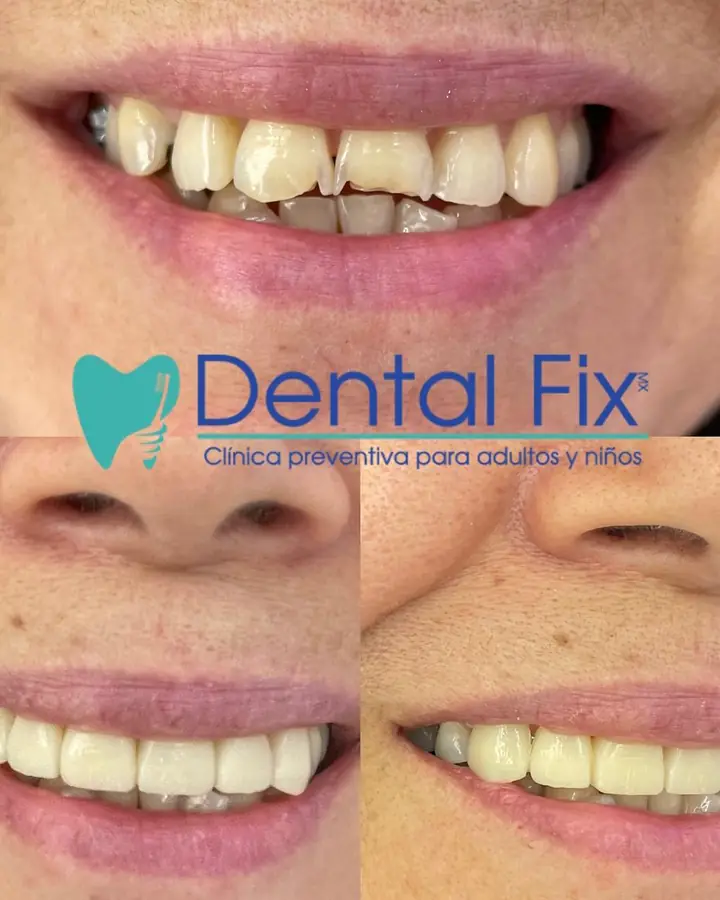 Diseño de sonrisa con acabado natural, antes y después