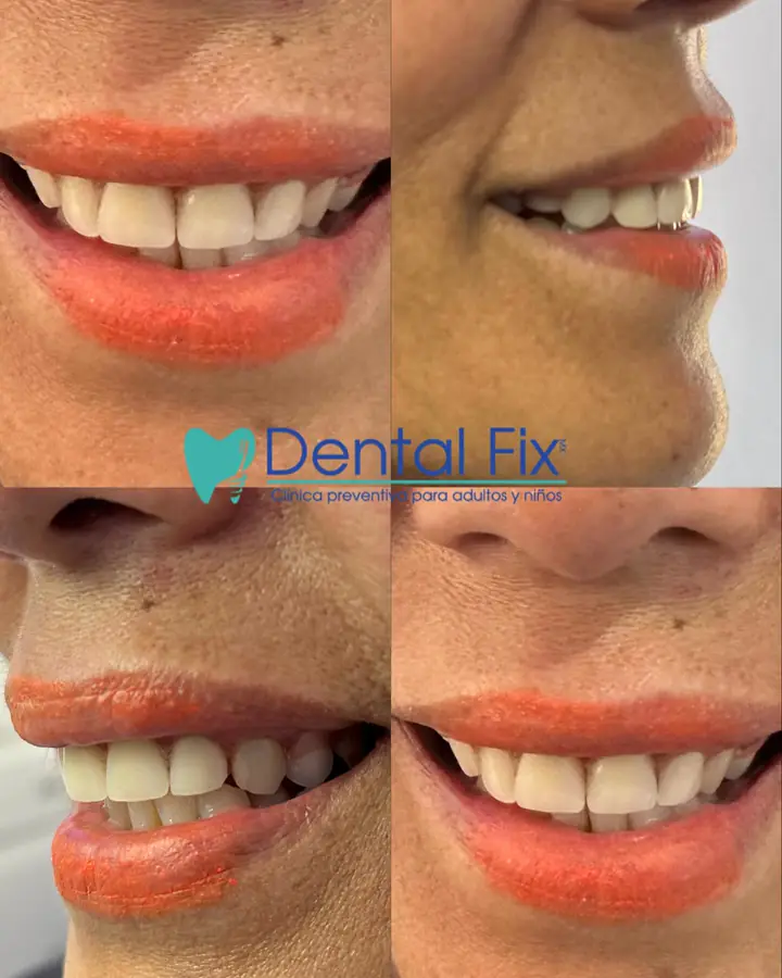 Recuperación de estética y función dental en dos citas