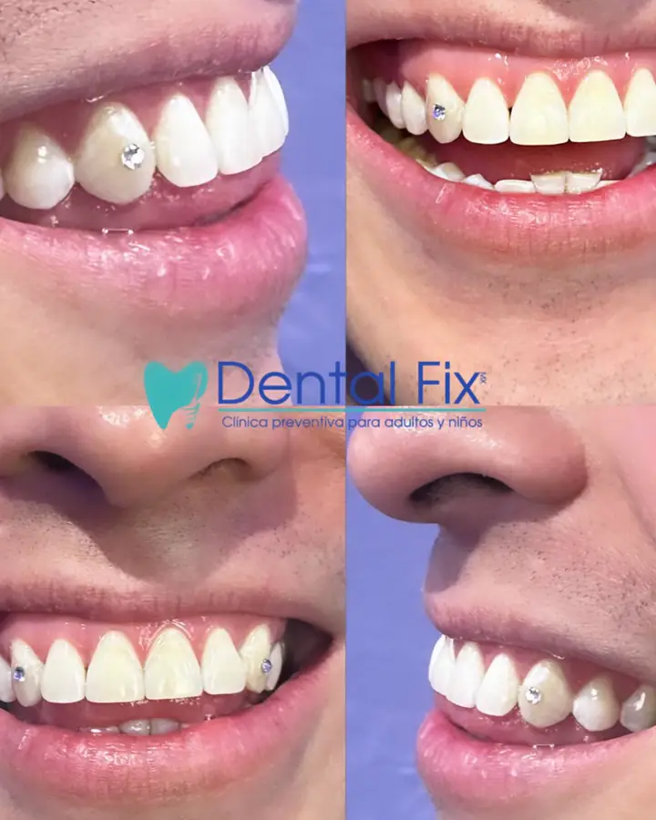 Gema dental colocada sobre una sonrisa ya tratada