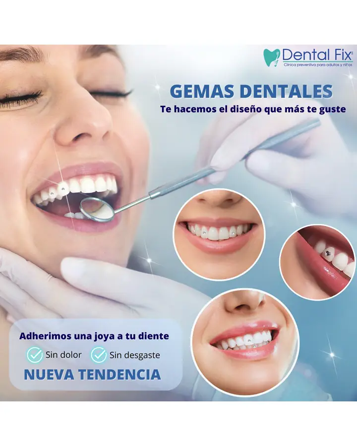 Colocación de una gema dental adherida sin desgastar el esmalte