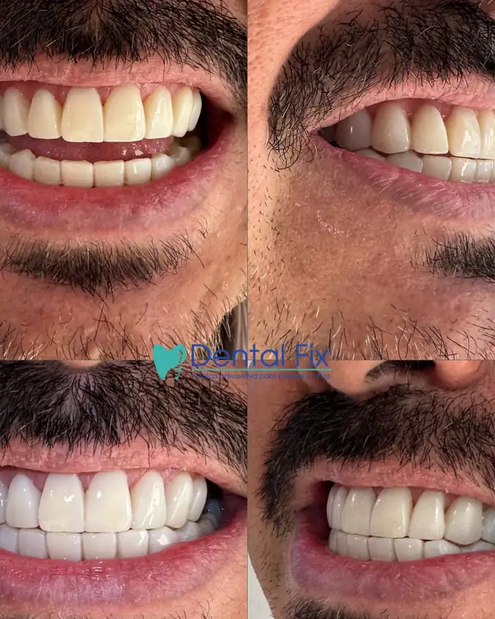 Nuevo diseño de sonrisa documentado en cuatro vistas