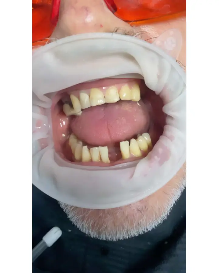 Boca con pérdida de varios dientes antes de la rehabilitación