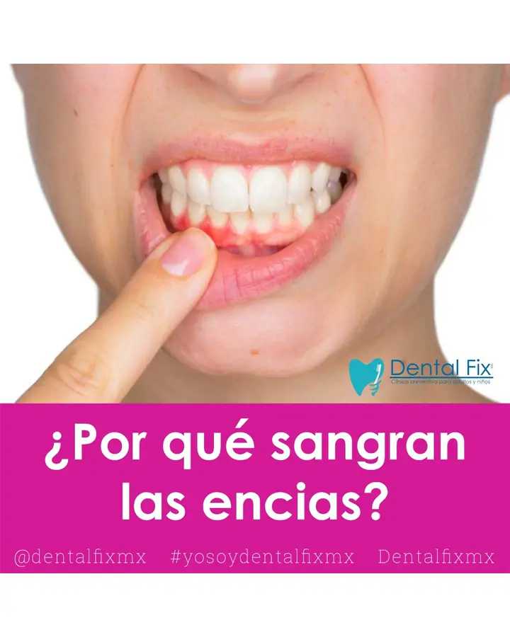 Encías inflamadas que sangran durante el cepillado