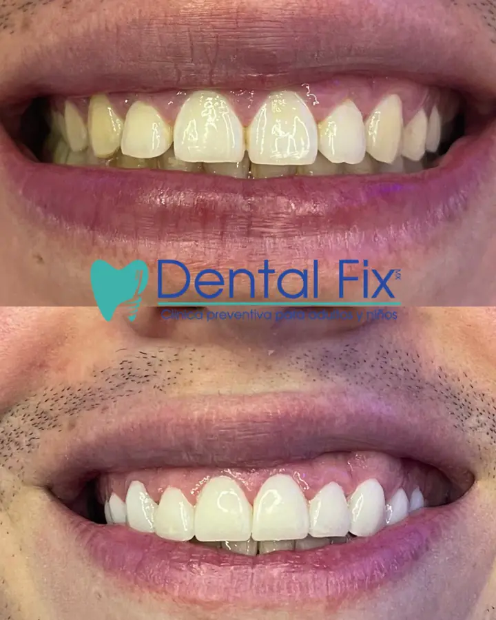 Resultado natural de un tratamiento estético dental