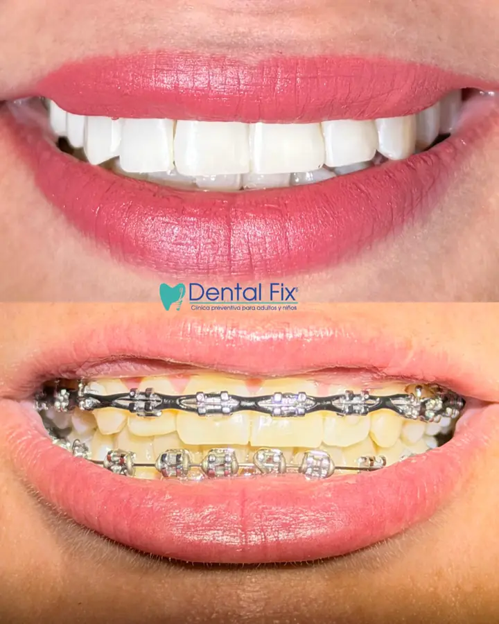 Resultado de una sonrisa alineada después de ortodoncia
