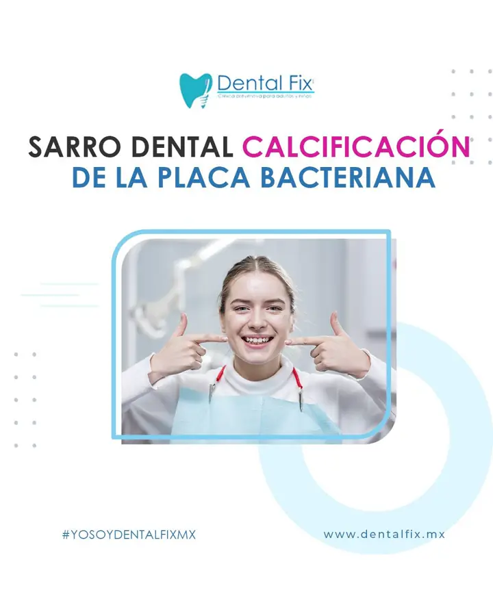 Sarro dental formado por calcificación de la placa bacteriana