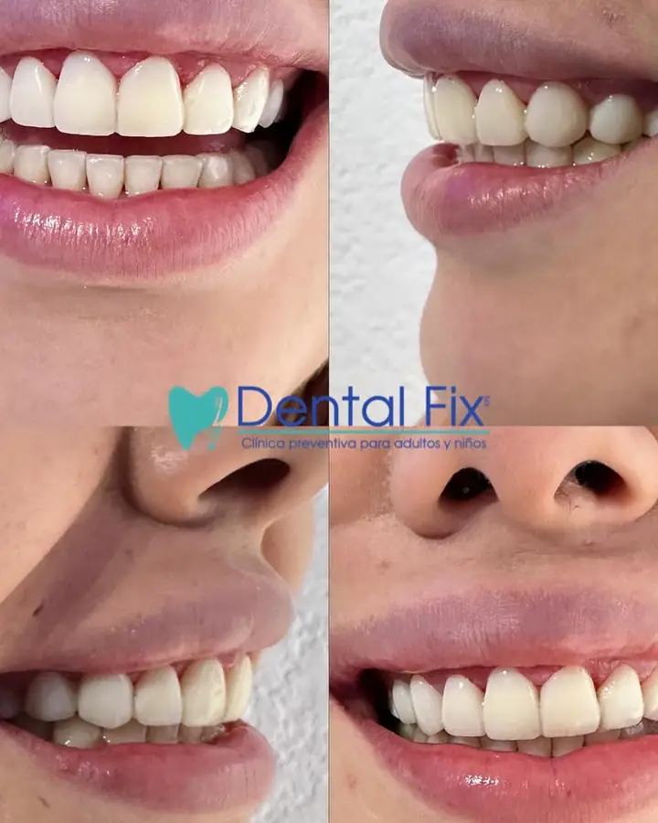 Sonrisa terminada después de retirar los brackets