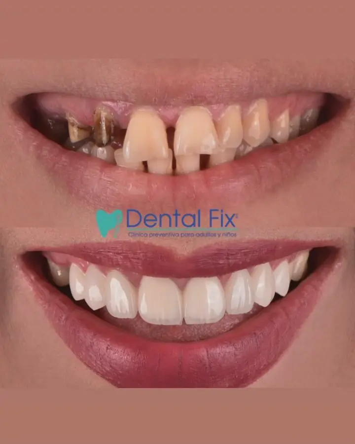 Antes y después de una rehabilitación completa de la sonrisa