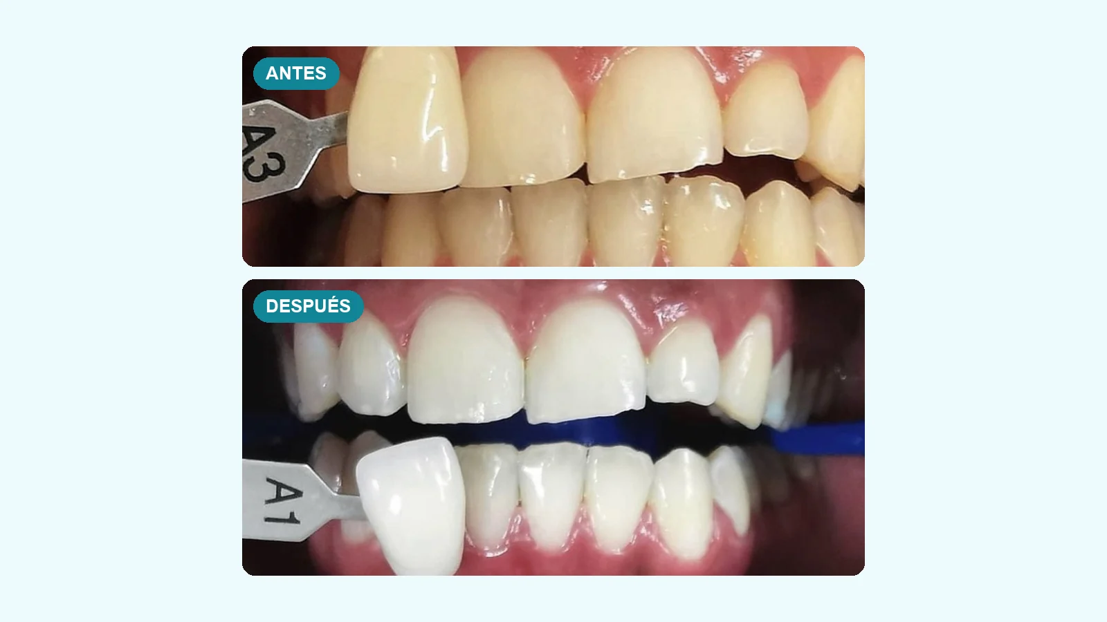 blanqueamiento dental antes y después medido con guía de tonos: de A3 a A1 en un paciente de DentalFix CDMX