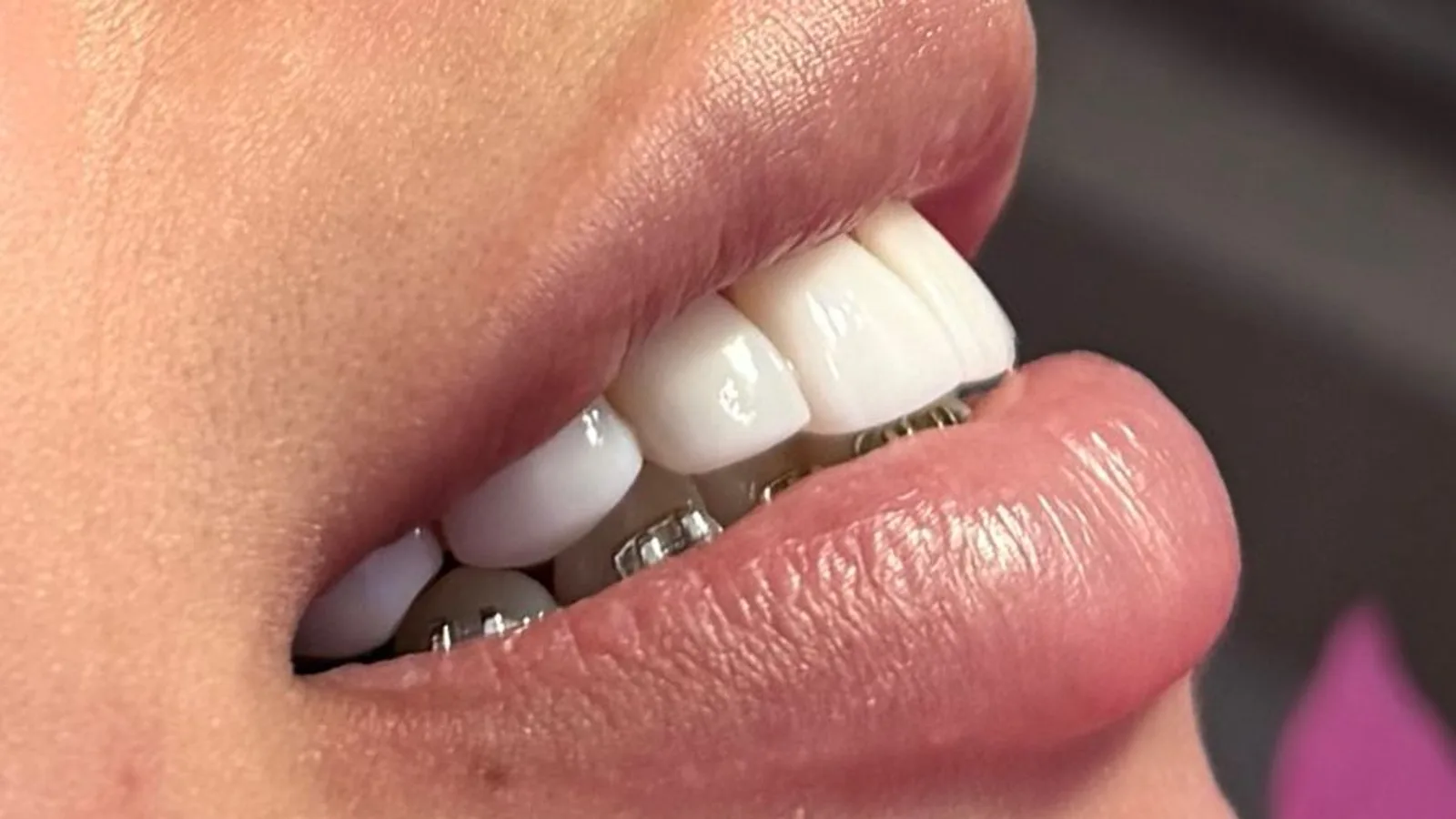 carillas dentales CDMX